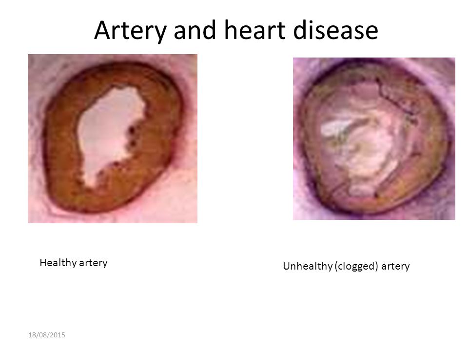 Artery and heart disease