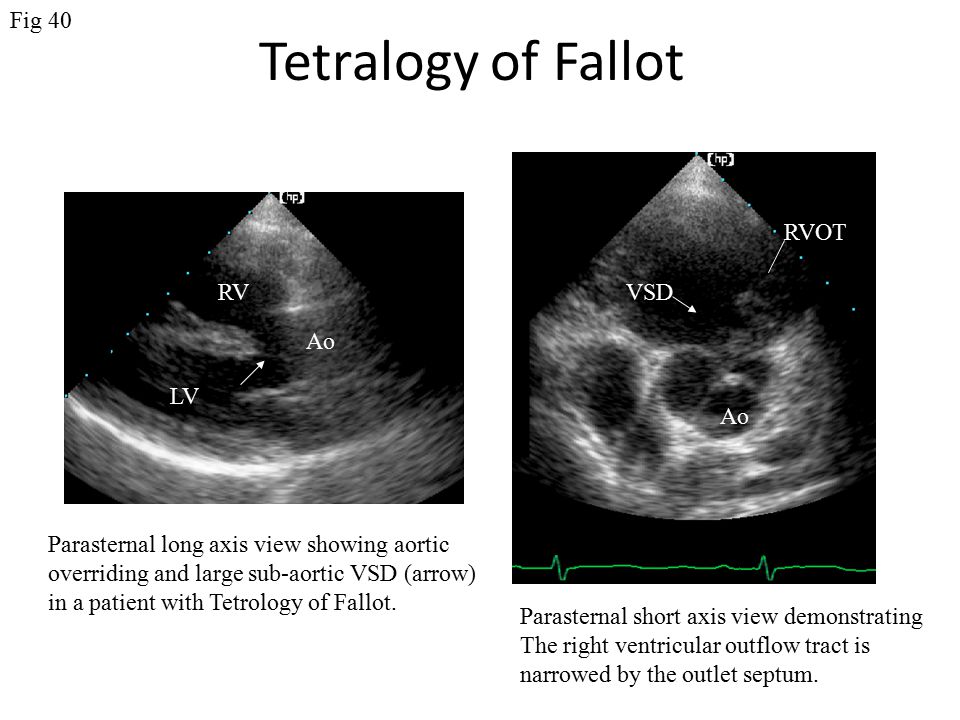 Tetralogy of Fallot Fig 40 RVOT RV VSD Ao LV Ao