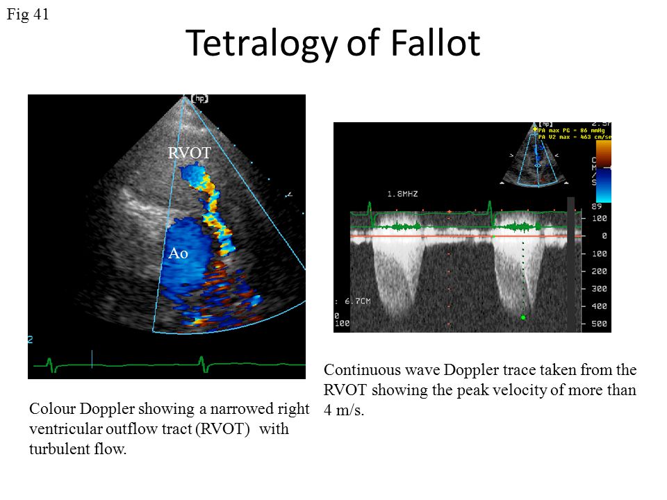 Tetralogy of Fallot Fig 41 RVOT Ao