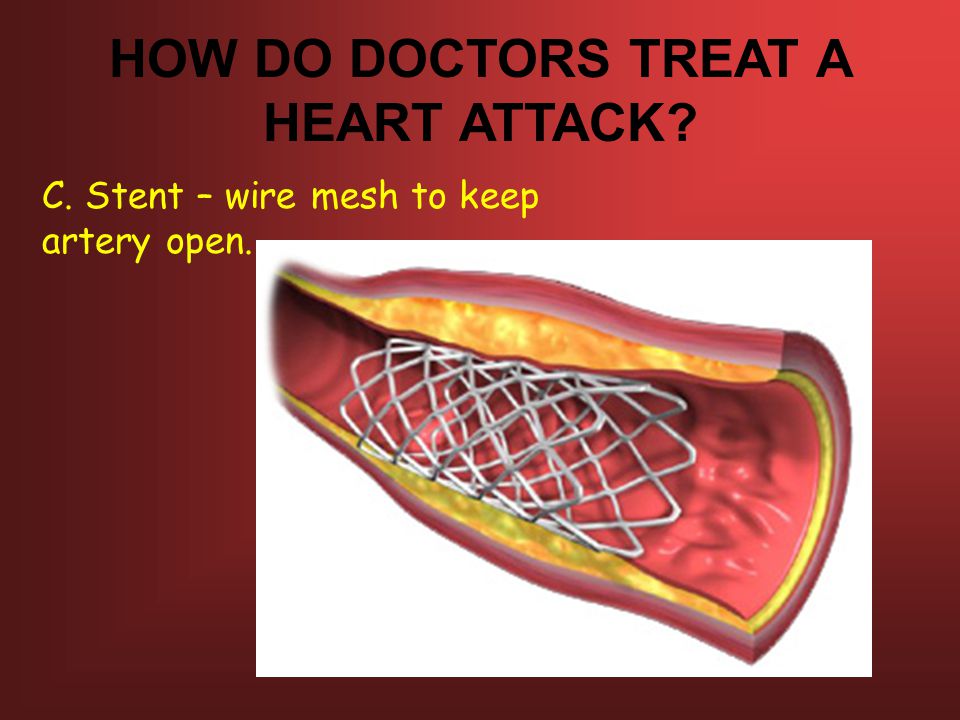 HOW DO DOCTORS TREAT A HEART ATTACK