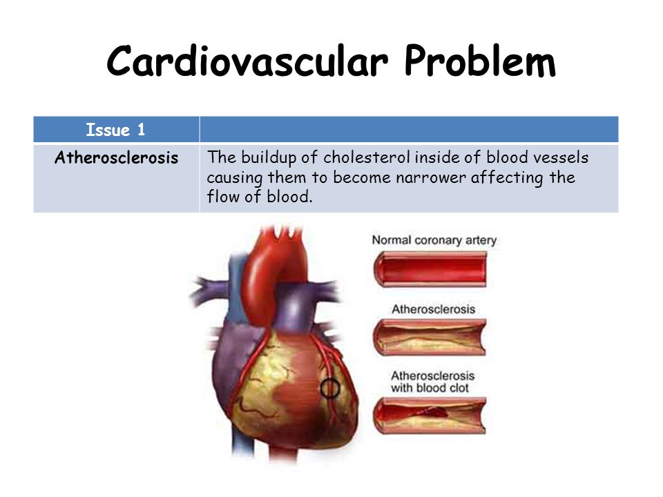 Cardiovascular Problem