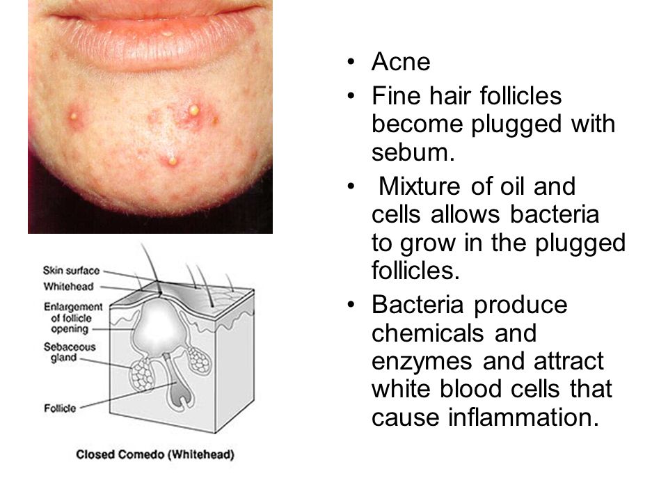 Acne Fine hair follicles become plugged with sebum. Mixture of oil and cells allows bacteria to grow in the plugged follicles.