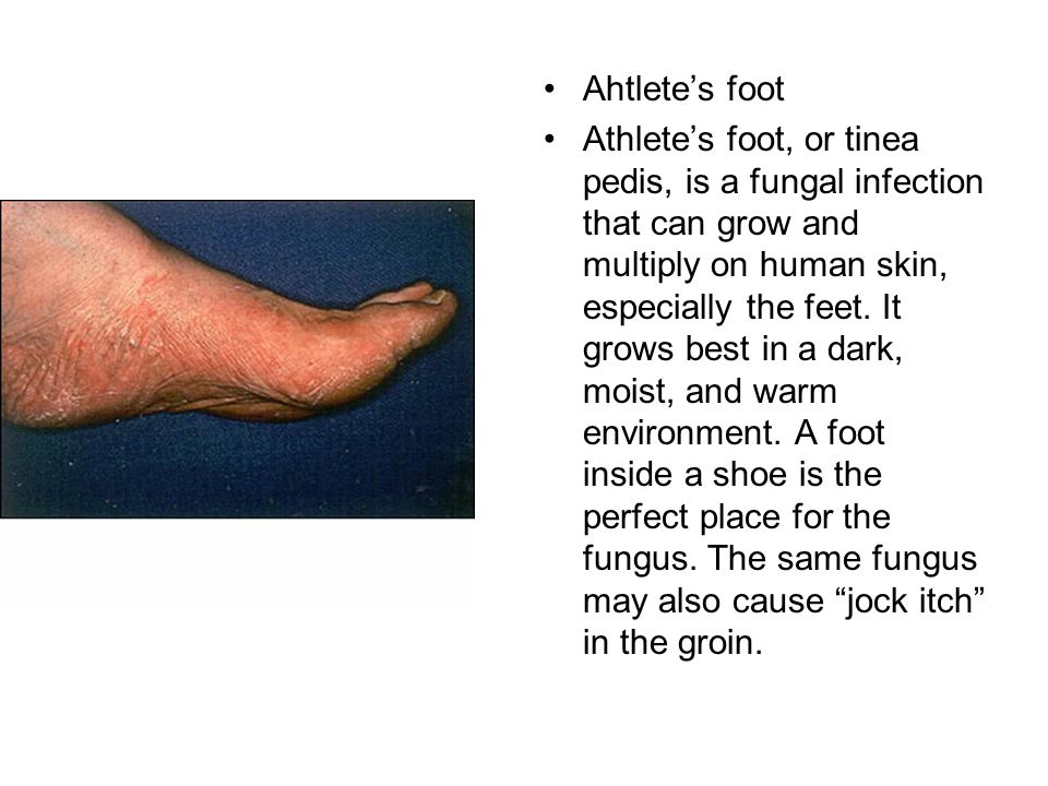 Ahtlete’s foot