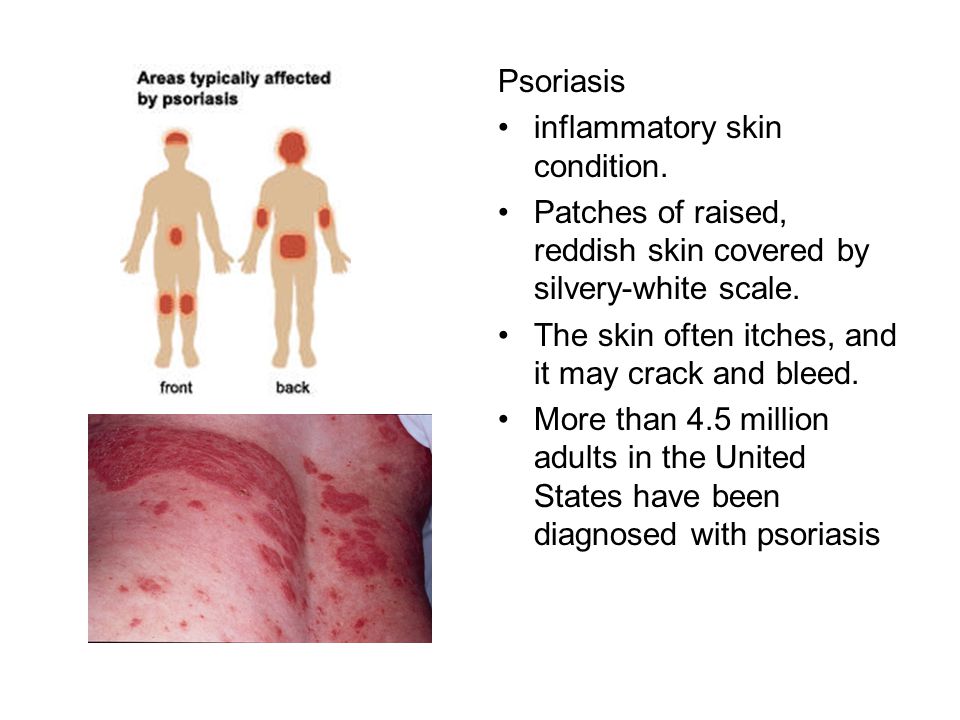 Psoriasis inflammatory skin condition. Patches of raised, reddish skin covered by silvery-white scale.