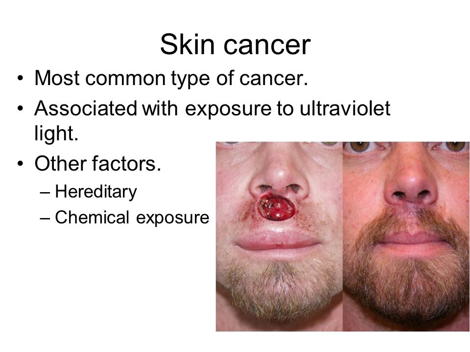 Skin cancer Most common type of cancer.