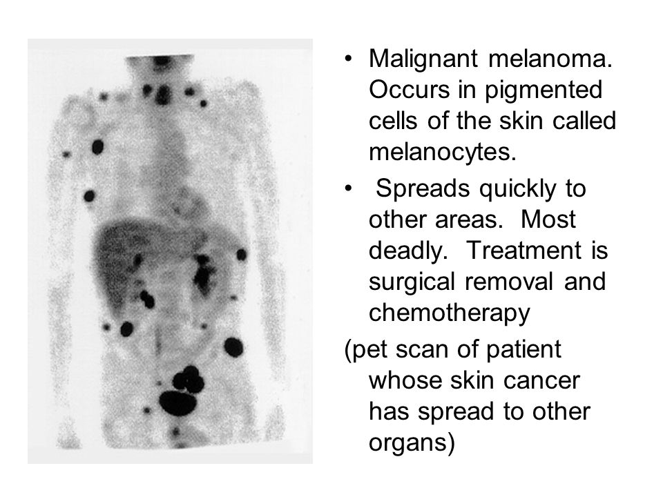 (pet scan of patient whose skin cancer has spread to other organs)