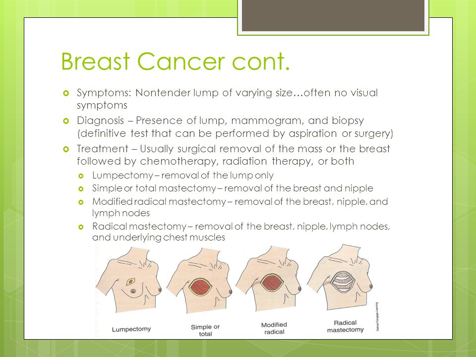 Breast Cancer cont. Symptoms: Nontender lump of varying size…often no visual symptoms.