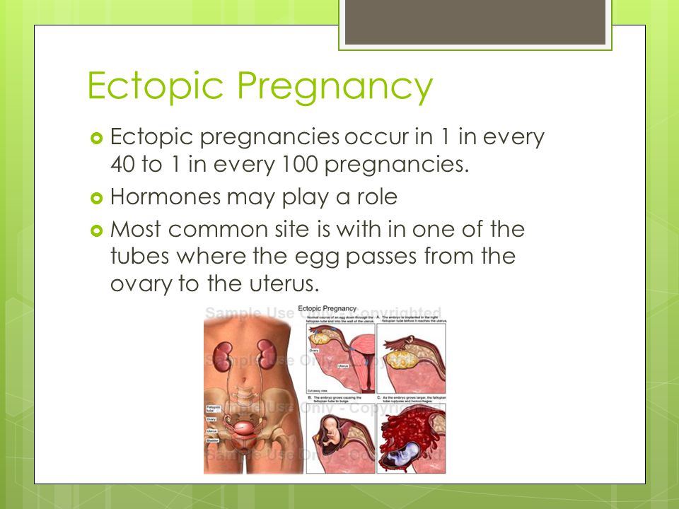 Ectopic Pregnancy Ectopic pregnancies occur in 1 in every 40 to 1 in every 100 pregnancies. Hormones may play a role.