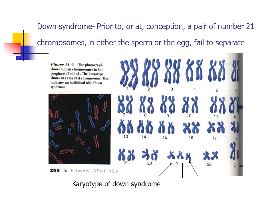Down syndrome- Prior to, or at, conception, a pair of number 21 chromosomes, in either the sperm or the egg, fail to separate