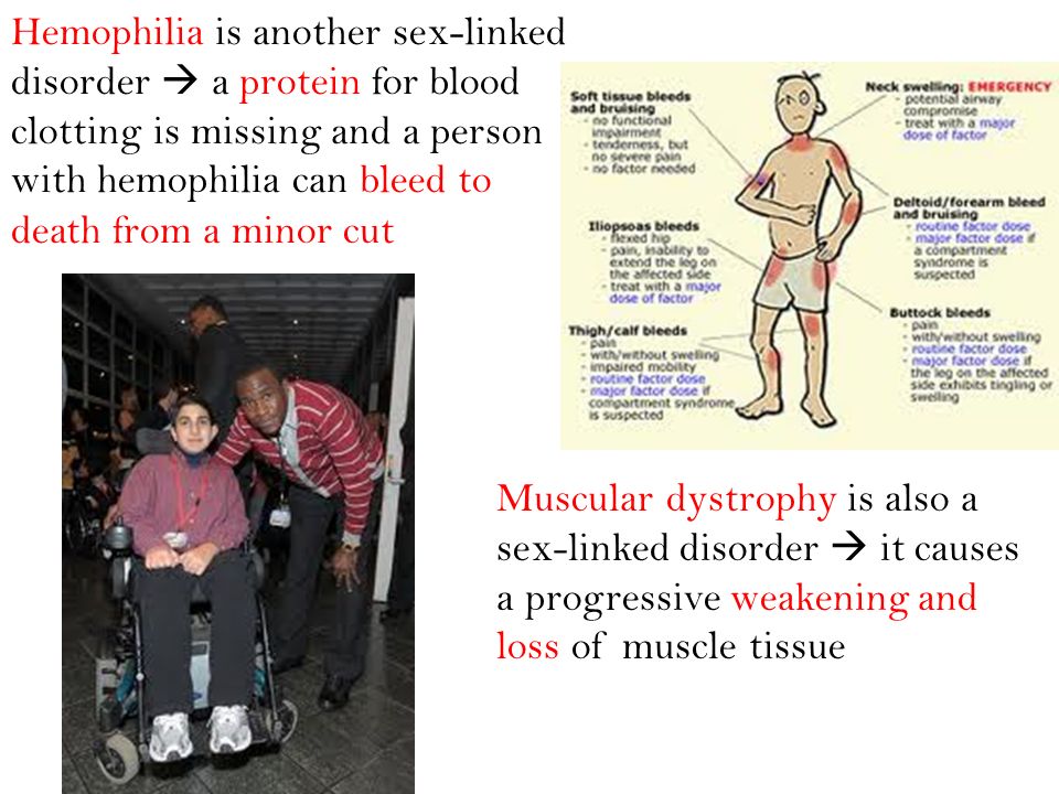 Hemophilia is another sex-linked disorder  a protein for blood clotting is missing and a person with hemophilia can bleed to death from a minor cut