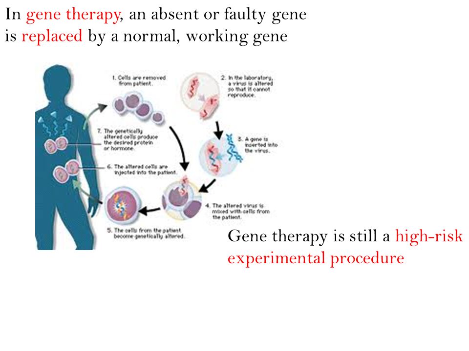 In gene therapy, an absent or faulty gene is replaced by a normal, working gene
