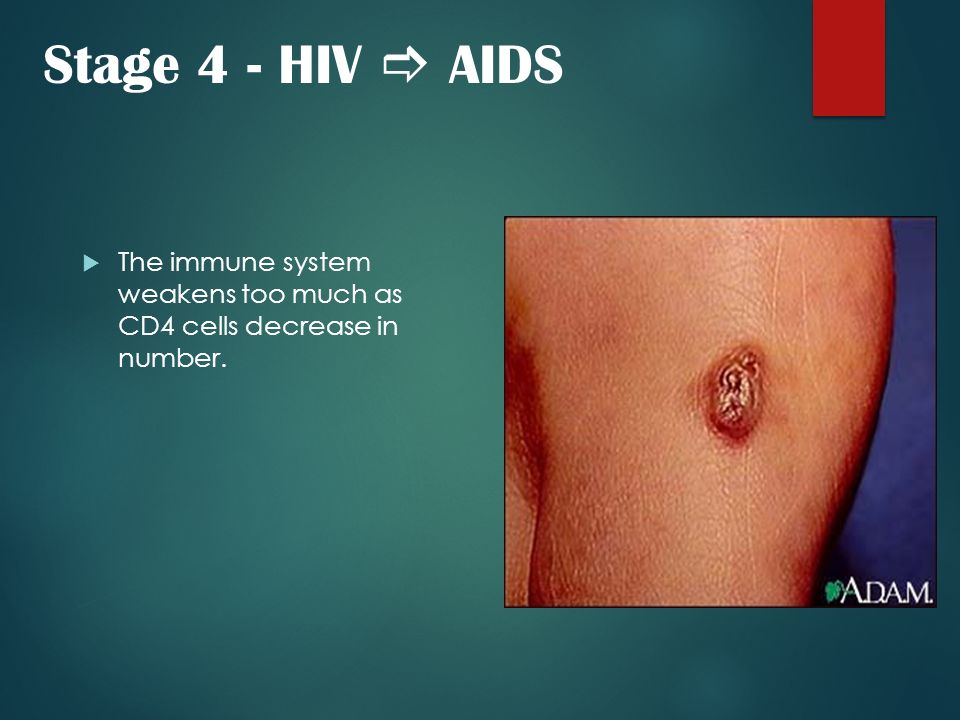 Stage 4 - HIV  AIDS The immune system weakens too much as CD4 cells decrease in number.