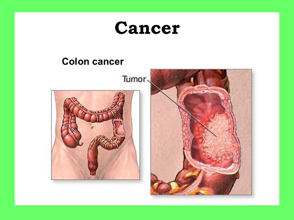 Cancer Colon cancer
