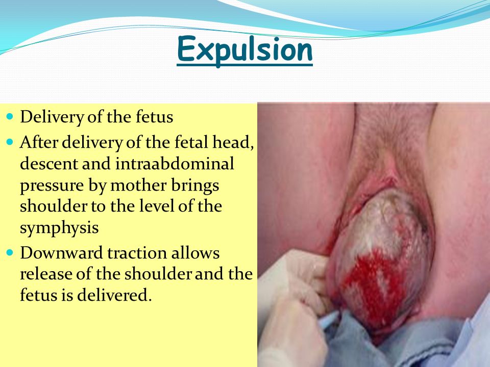 Expulsion Delivery of the fetus