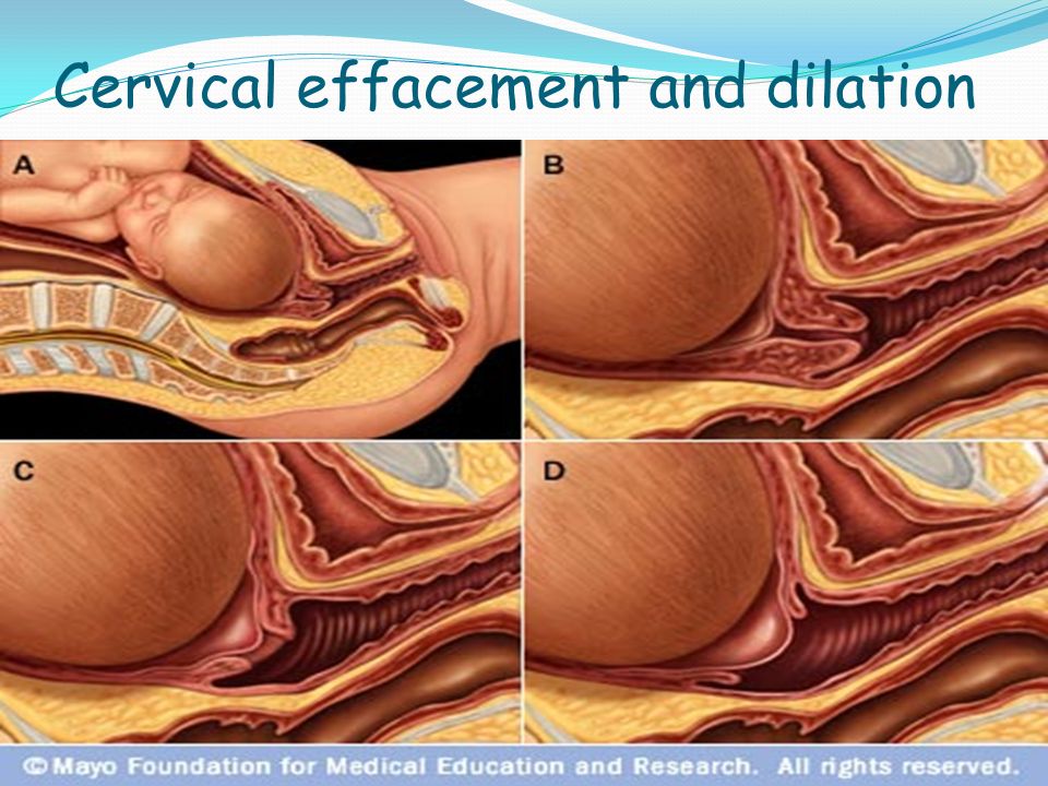 Cervical effacement and dilation