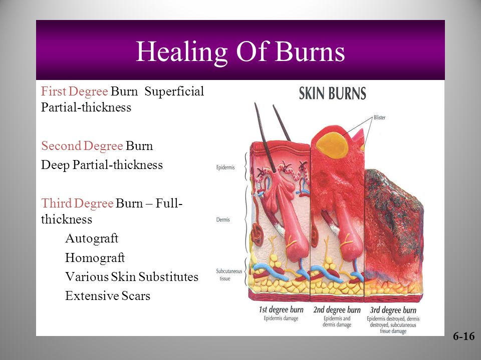Healing Of Burns