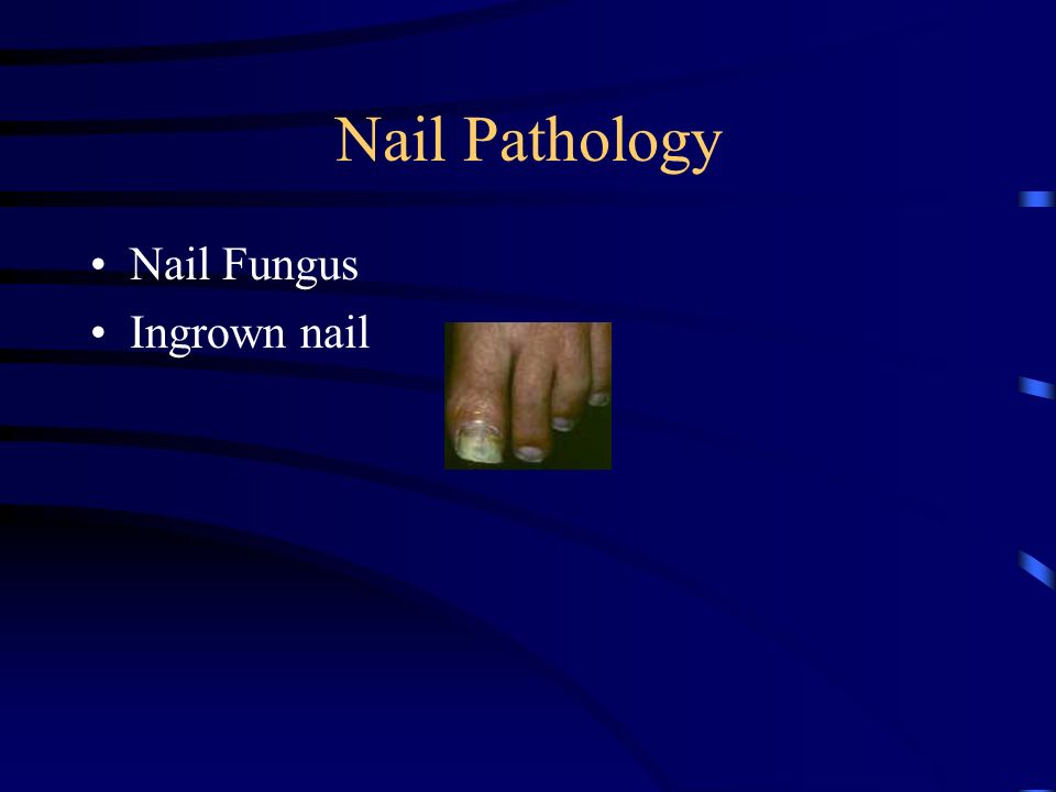 Nail Pathology Nail Fungus Ingrown nail