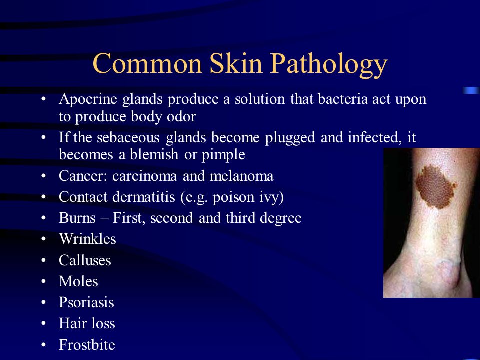 Common Skin Pathology Apocrine glands produce a solution that bacteria act upon to produce body odor.