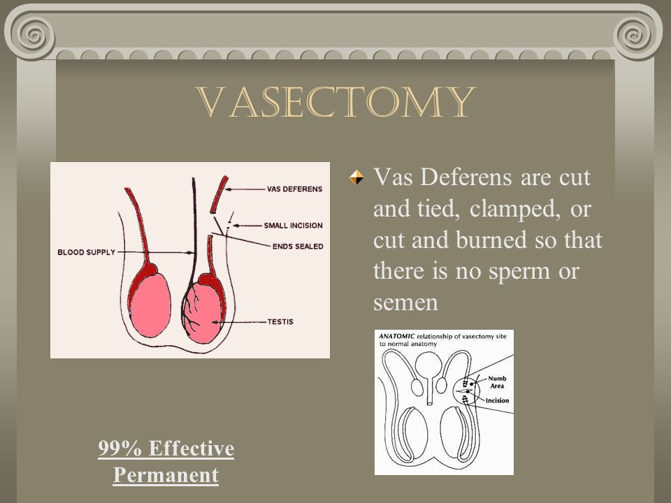 vasectomy Vas Deferens are cut and tied, clamped, or cut and burned so that there is no sperm or semen.