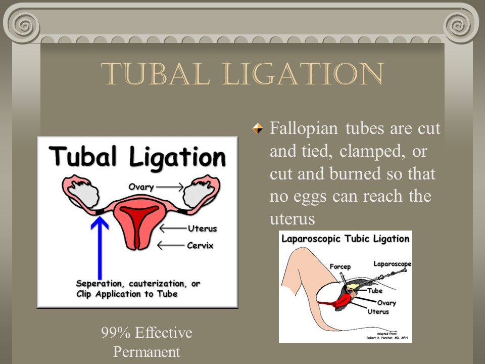 Tubal Ligation Fallopian tubes are cut and tied, clamped, or cut and burned so that no eggs can reach the uterus.