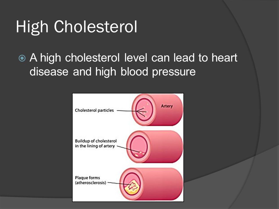 High Cholesterol A high cholesterol level can lead to heart disease and high blood pressure