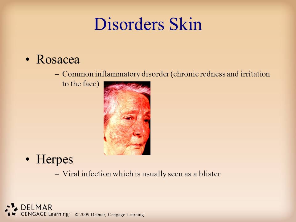 Disorders Skin Rosacea Herpes