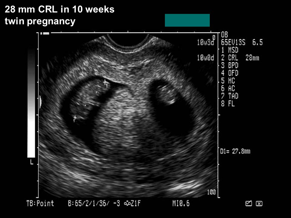 28 mm CRL in 10 weeks twin pregnancy 18 4/21/