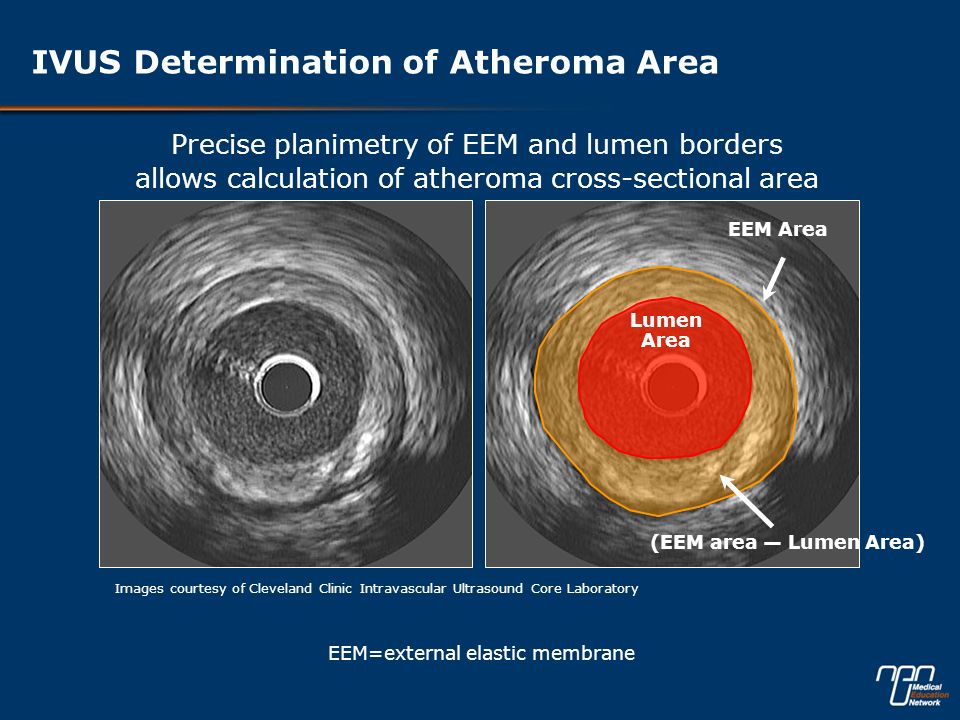 IVUS Determination of Atheroma Area