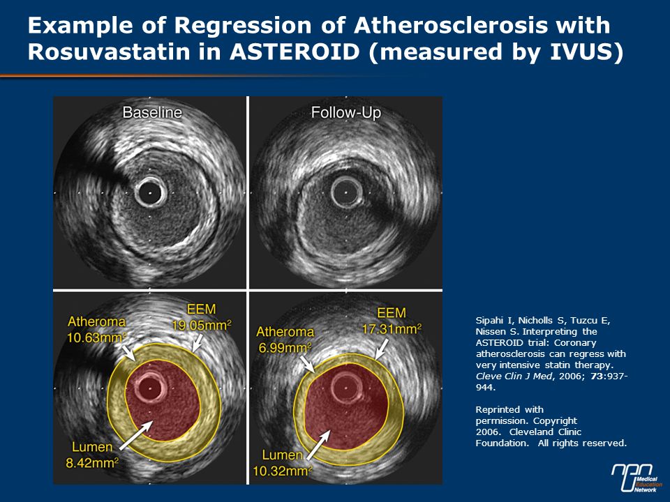 Example of Regression of Atherosclerosis with Rosuvastatin in ASTEROID (measured by IVUS)