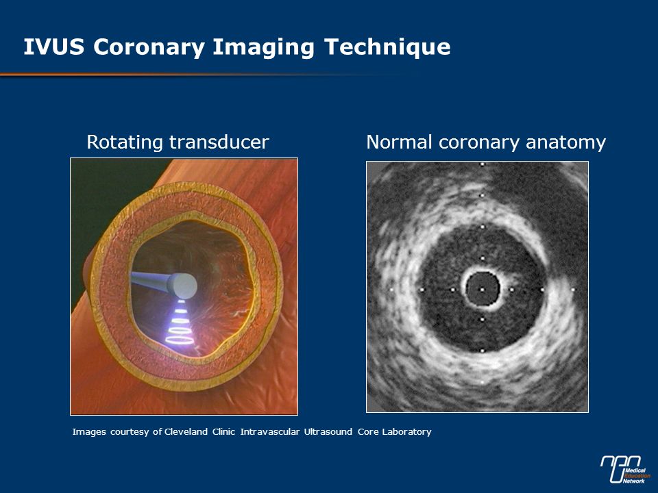 IVUS Coronary Imaging Technique