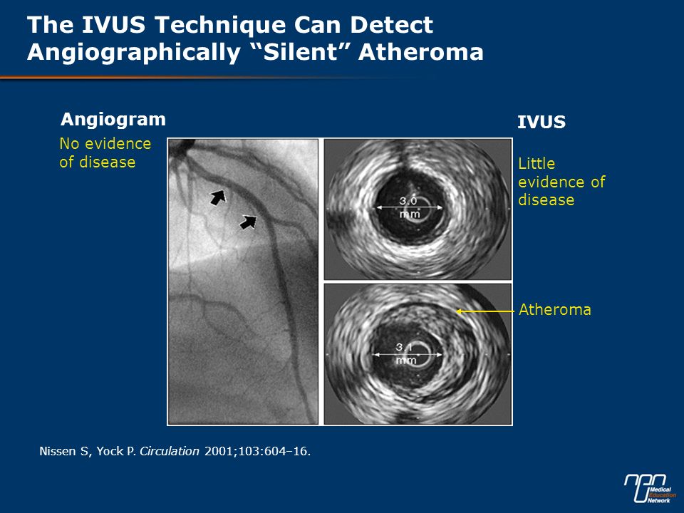 The IVUS Technique Can Detect Angiographically Silent Atheroma