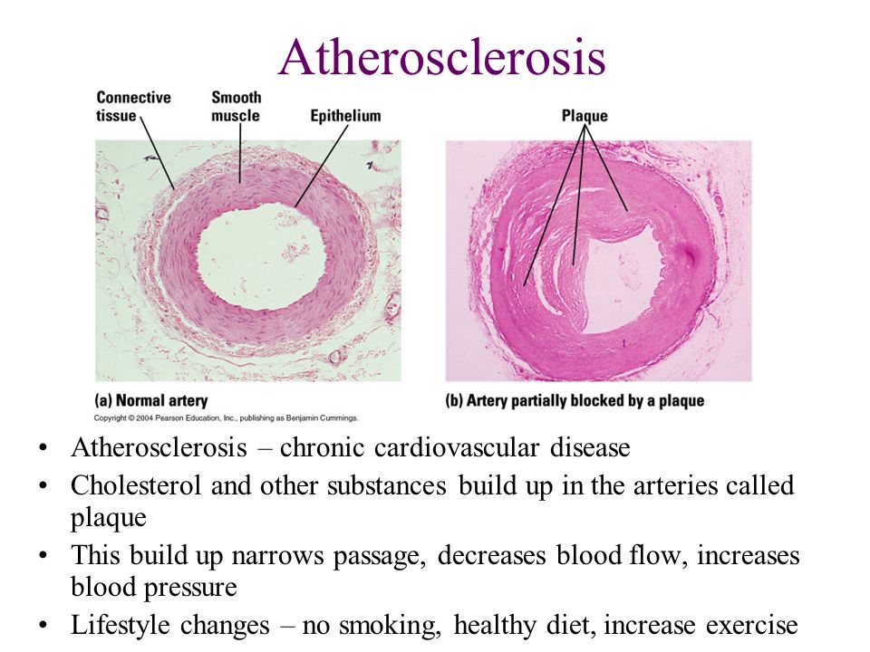 Atherosclerosis Atherosclerosis – chronic cardiovascular disease