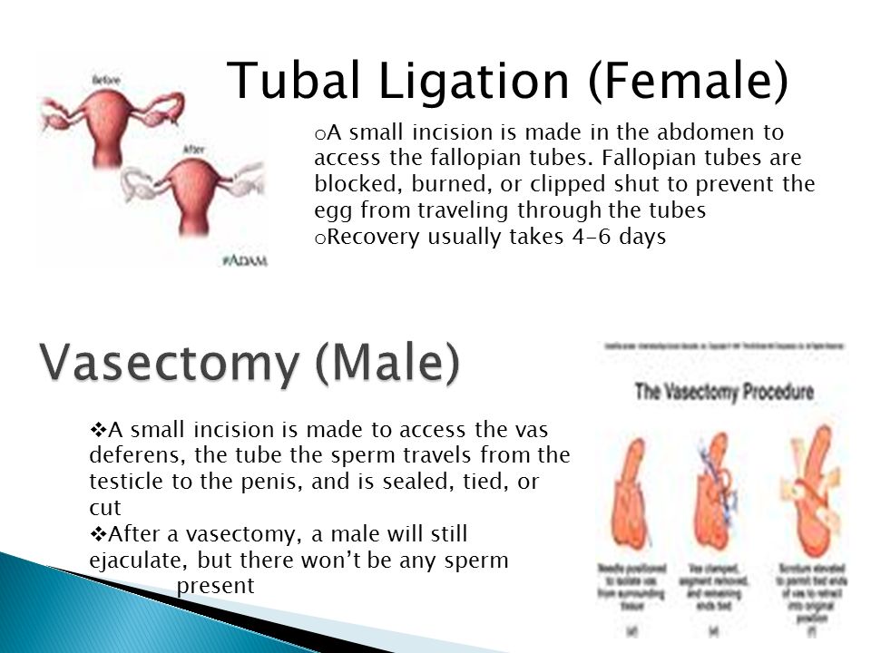 Tubal Ligation (Female)