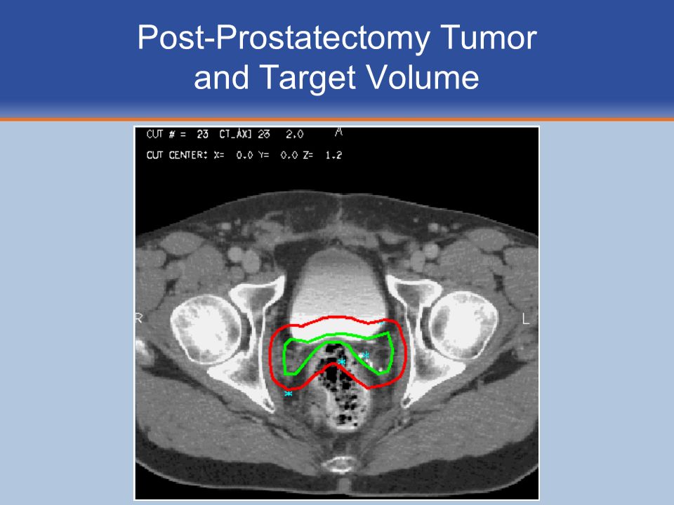Post-Prostatectomy Tumor and Target Volume