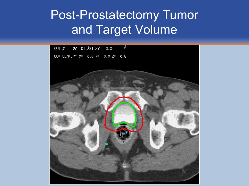 Post-Prostatectomy Tumor and Target Volume