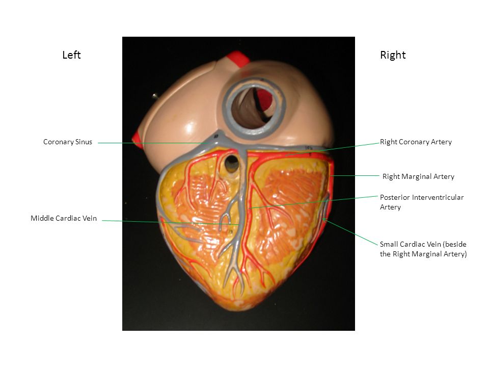 Left Right Coronary Sinus Right Coronary Artery Right Marginal Artery