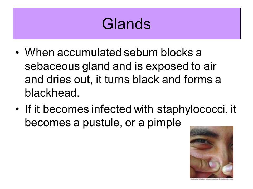 pustule,cyst if it becomes infected with staphylococci, it becomes a pustule