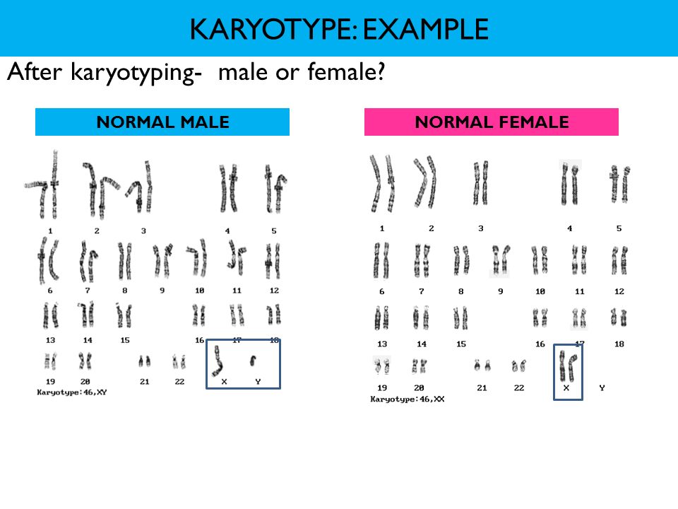 After karyotyping- male or female