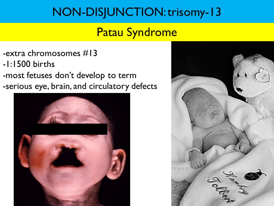 NON-DISJUNCTION: trisomy-13