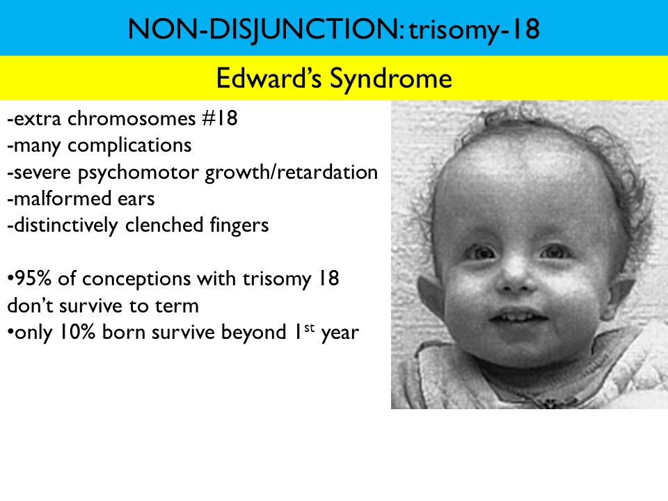 NON-DISJUNCTION: trisomy-18