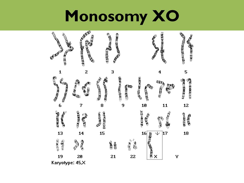 Monosomy XO