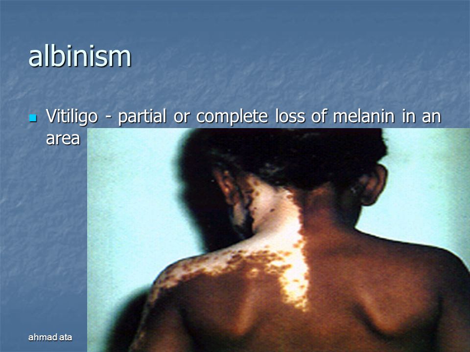albinism Vitiligo - partial or complete loss of melanin in an area