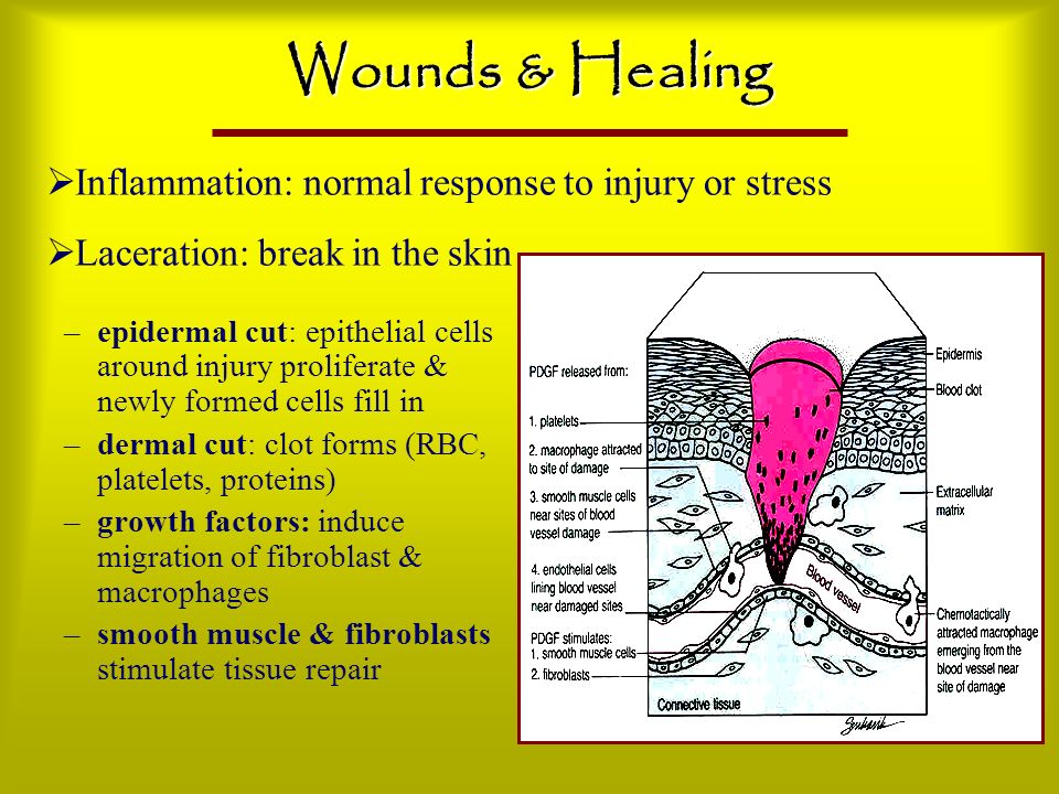 Wounds & Healing Inflammation: normal response to injury or stress