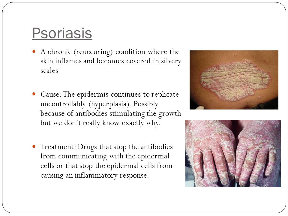 Psoriasis A chronic (reuccuring) condition where the skin inflames and becomes covered in silvery scales.