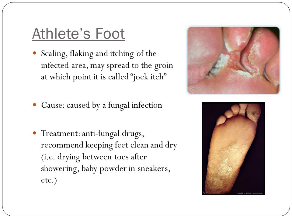 Athlete’s Foot Scaling, flaking and itching of the infected area, may spread to the groin at which point it is called jock itch