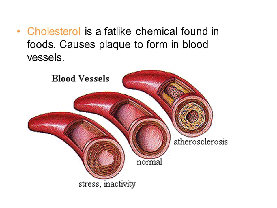Cholesterol is a fatlike chemical found in foods