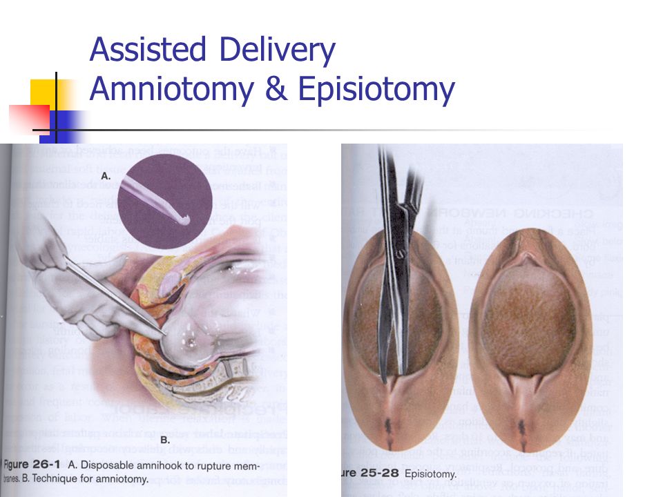 amniotomy