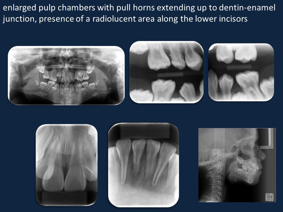 enlarged pulp chambers with pull horns extending up to dentin-enamel junction, presence of a radiolucent area along the lower incisors