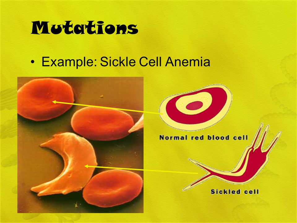 Mutations Example: Sickle Cell Anemia