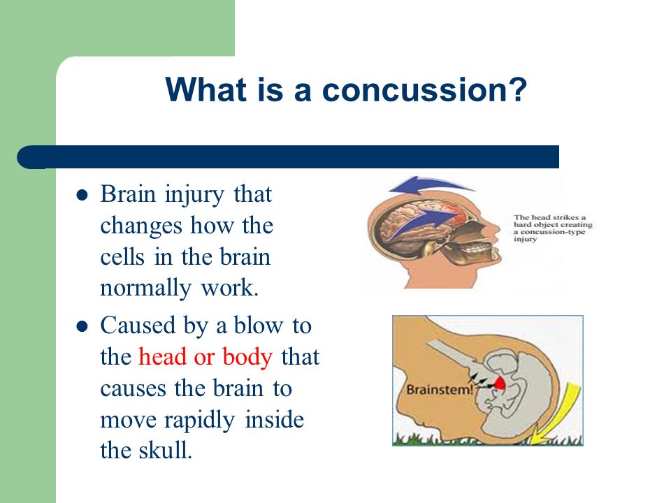 What is a concussion Brain injury that changes how the cells in the brain normally work.